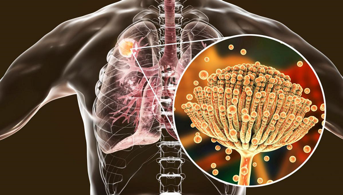 Hongos en los pulmones